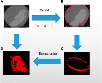 Correlation between epicardial adipose tissue and myocardial injury in patients with COVID-19